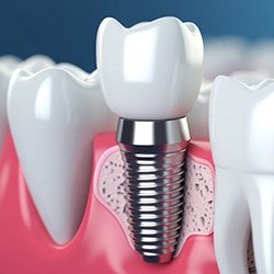 a 3D depiction of a dental implant in the jawbone