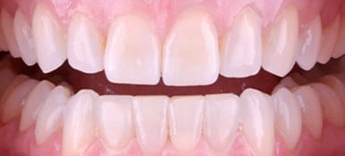 White healthy smile after