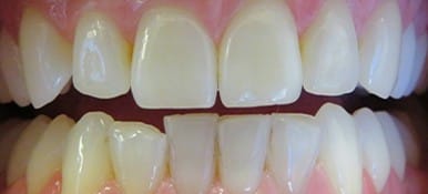 Yellow teeth before