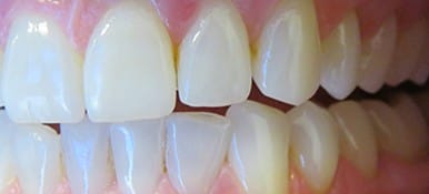 Brighter white staining on teeth before