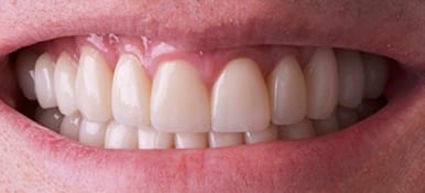 Healthy white teeth after