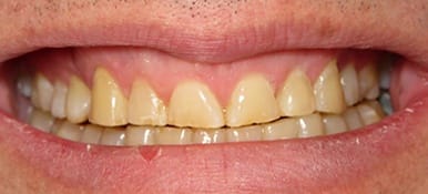 Yellow damaged teeth before