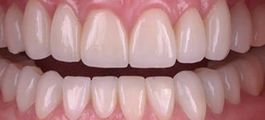 Healthy white properly aligned smile after