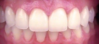 Seamlessly repaired chips in front teeth
