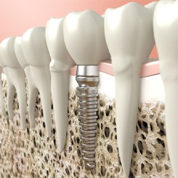 Digital illustration of a single dental implant