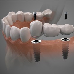 Digital illustration of an implant bridge