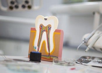 Model of tooth with root canal damage