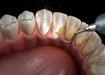 Digital image of a dental cleaning being done