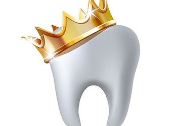 illustration of Dental crowns in Falls Church 