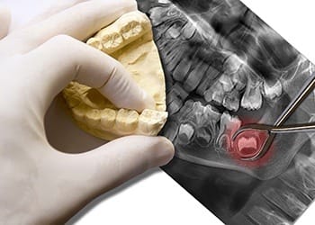 X-ray and model of wisdom tooth