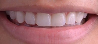 Teeth flawlessly repaired