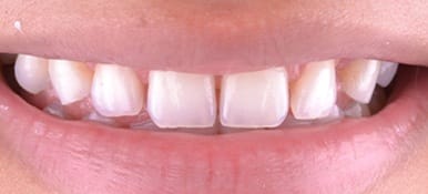 Teeth with yellow lines in enamel
