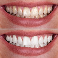 a patient smiling after receiving teeth whitening in Falls Church