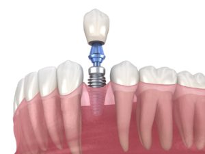 Model showing each part of a dental implant